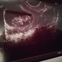 Metodo saad ramzi para saber el sexo del bebe - 1