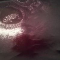 Ayuda con método ramzi: niño o niña? - 1