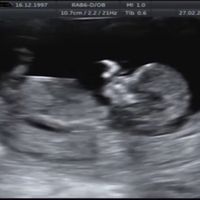 Buscadoras después de uno o varios abortos iii - 1