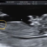 Tubérculo genital: niña - 1