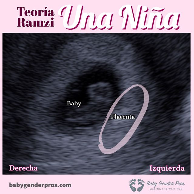 Ayuda con método ramzi: niño o niña? - 1
