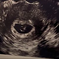 Ayuda con método ramzi: niño o niña? - 2