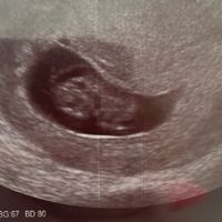Ayuda con método ramzi: niño o niña? - 1