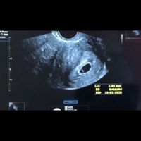 Ayuda con método ramzi: niño o niña? - 2