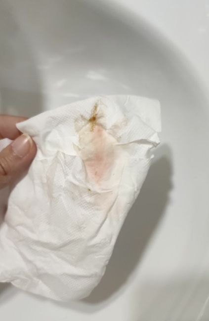 Sangrado de implantación o principio de regla? - 1