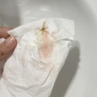 Sangrado de implantación o principio de regla? - 1