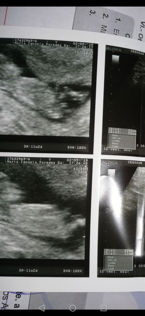 Tubérculo genital: niña - 1