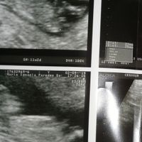Tubérculo genital: niña - 1
