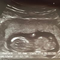 Ayuda con método ramzi: niño o niña? - 2