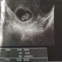 Ayuda con método ramzi: niño o niña? - 1