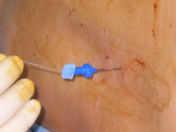 anestesia epidural