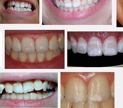 Manchas blancas en los dientes de los niños