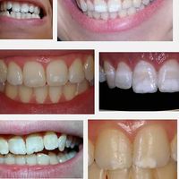 Manchas blancas en los dientes de los niños