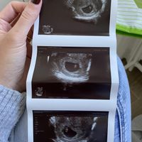 Ayuda con método ramzi: niño o niña? - 1