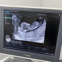 Ayuda con método ramzi: niño o niña? - 2