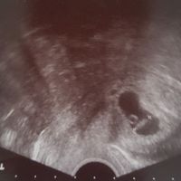 Ayuda con método ramzi: niño o niña? - 1