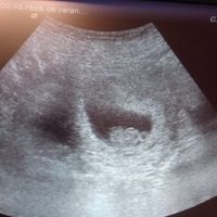 Ayuda con método ramzi: niño o niña? - 2