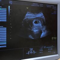 Ayuda con método ramzi: niño o niña? - 1