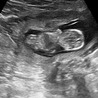 Ayuda con método ramzi: niño o niña? - 1