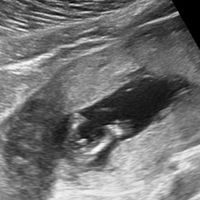 Ayuda con método ramzi: niño o niña? - 2