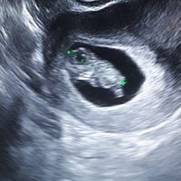 Ayuda con método ramzi: niño o niña? - 1