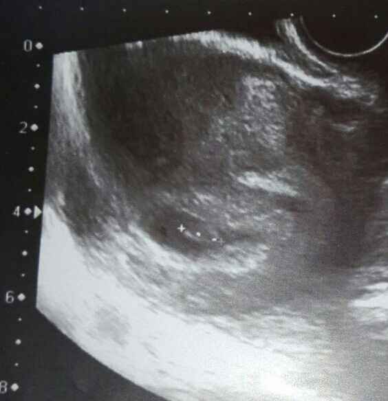 7SEMANAS, ECO TRANSVAGINAL. NIÑO O NIÑA? ALGUIEN ME SABRÍA DECIRME? GRACIAS