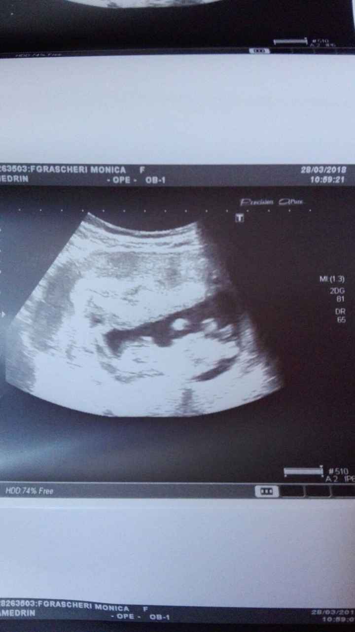 SEXO DEL BEBE
