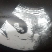 8 SEM Y 2 DÍAS, ECO ABDOMINAL, NIÑO O NIÑA?