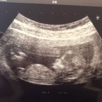 Ayuda con método ramzi: niño o niña? - 1