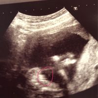 Ayuda con método ramzi: niño o niña? - 1