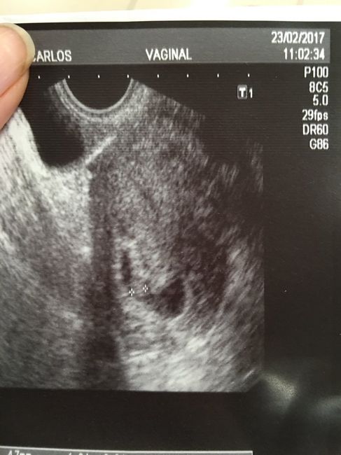 Buscadoras después de uno o varios abortos ii - 3