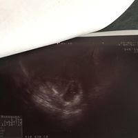 Buscadoras después de uno o varios abortos ii - 1