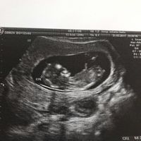 Buscadoras después de uno o varios abortos ii - 1