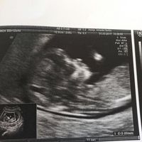Buscadoras después de uno o varios abortos ii - 2