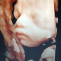 Buscadoras después de uno o varios abortos ii - 1