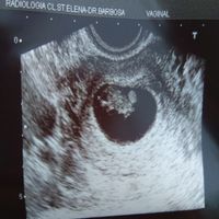 Ayuda con método ramzi: niño o niña? - 1