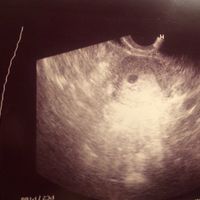Ayuda con método ramzi: niño o niña? - 1