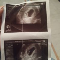 Ayuda con método ramzi: niño o niña? - 1