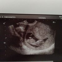 Ayuda con método ramzi: niño o niña? - 1