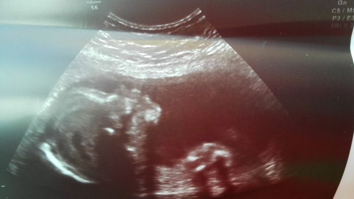20 semanas