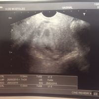 Mi bebe de 7+6 semanas