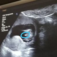 Ayuda con método ramzi: niño o niña? - 1
