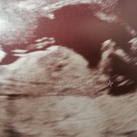 Ayuda con método ramzi: niño o niña? - 1