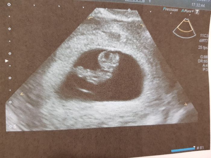 Ayuda con método ramzi: niño o niña? 26