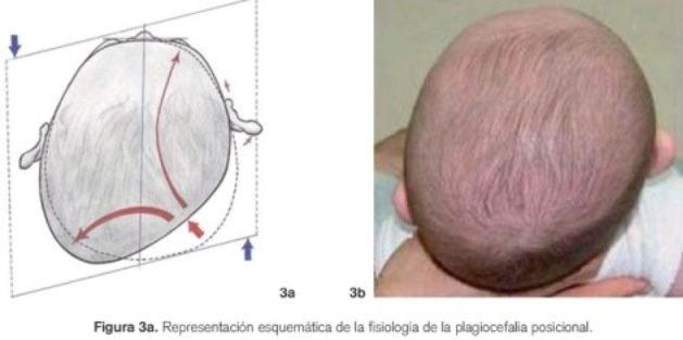 Plagiocefalia - 1