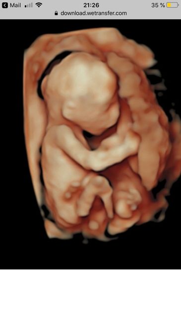 Ayuda con método ramzi: niño o niña? - 1