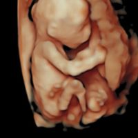 Ayuda con método ramzi: niño o niña? - 1
