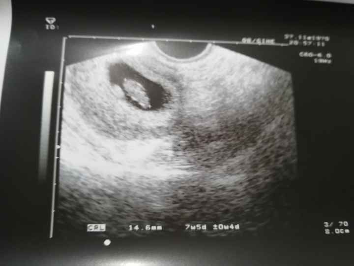 Ayuda con método ramzi: niño o niña? - 1