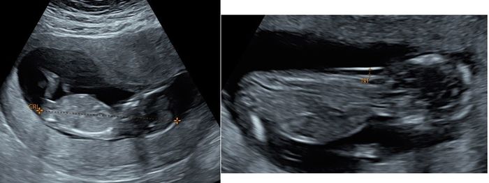 Tubérculo genital: niña 12