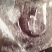 Tubérculo genital: niña - 1